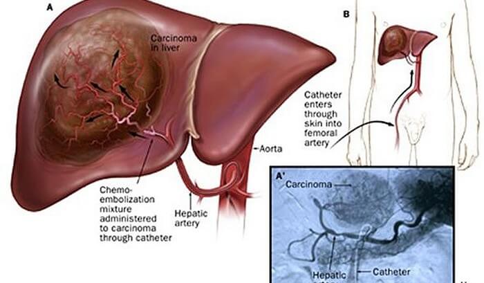 Embolization for Liver Cancer