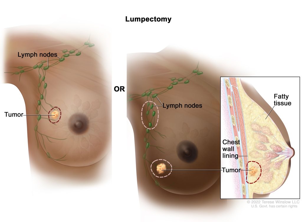 lumpectomy