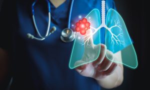 is lung cancer curable