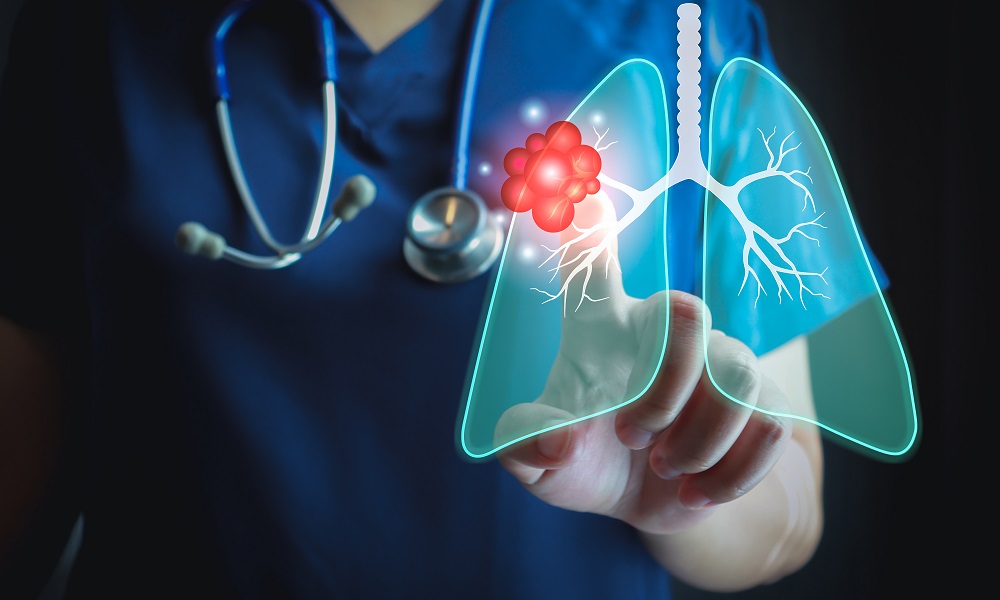 is lung cancer curable