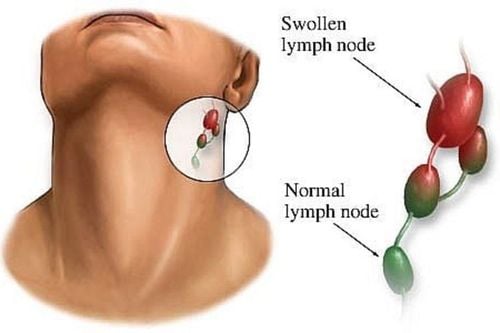 neck cancer lymph nodes